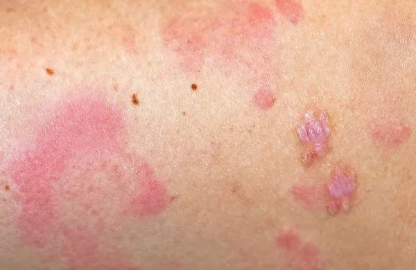 Za urtikarijo so značilni izpuščaji, ki srbijo.