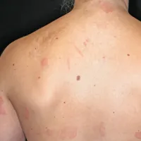 Tvorbe se pojavijo tudi po hrbtu in vratu. 