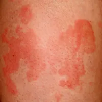 Pogosto izpuščaji zavzemajo cele zaplate in so za prizadetega zelo moteči ter skeleči. 