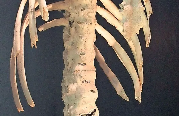 Ankilozirajoči spondilitis