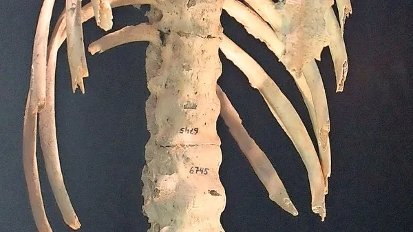 Ankilozirajoči spondilitis