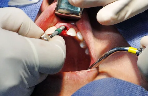 Vstavljanje implantata