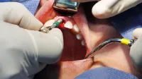Vstavljanje implantata