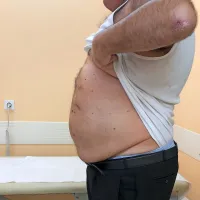 Bolnik po uspešni operaciji velike trebušne kile. 