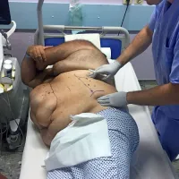 Mesec pred operacijo so bolniku vbrizgali botoks toksin v predela, 
kamor so se “umaknile” mišice.