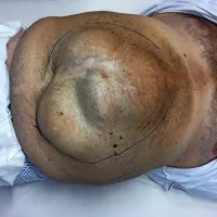 Bolnikov trebuh z  veliko kilo pred operacijo