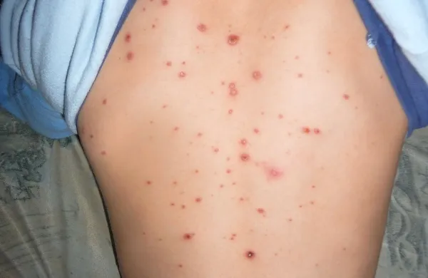 V primeru vodenih   koz bolnišnično  zdravljenje običajno ni potrebno, sicer pa imajo na izolskem oddelku za pediatrijo   22 postelj 
za  pediatrične  in 14 za  kirurške paciente, premorejo tudi  17 
pomožnih ležišč.