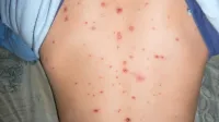 V primeru vodenih   koz bolnišnično  zdravljenje običajno ni potrebno, sicer pa imajo na izolskem oddelku za pediatrijo   22 postelj 
za  pediatrične  in 14 za  kirurške paciente, premorejo tudi  17 
pomožnih ležišč.
