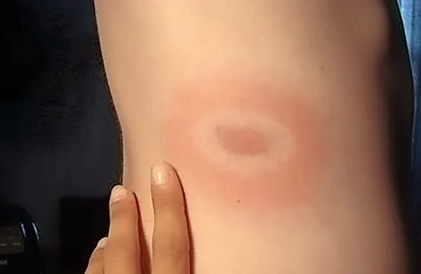 Za lymsko boreliozo je značilen pojav na koži z rdečino na sredini 
in belim kolobarjem, kar zahteva nujen obisk pri zdravniku. 