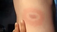 Za lymsko boreliozo je značilen pojav na koži z rdečino na sredini 
in belim kolobarjem, kar zahteva nujen obisk pri zdravniku. 