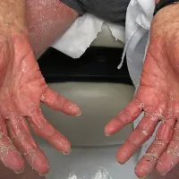 Pri odraslih je pogosto potek bolezni veliko težji.  