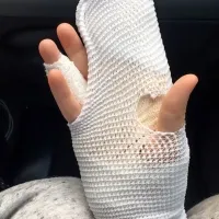 Teden dni po napadu ima Tea še vedno povite številne rane. 
Najhujše so na roki in na stegnu. 