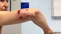 Najbolj globo so se pasji čekani zarili  v desno roko,  na urgenci pa 
so ji oskrbeli še ugrize na stegnu in hrbtu.