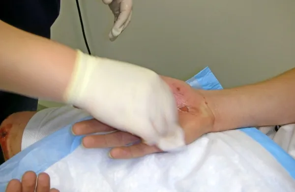 Patronažne sestre skušajo  za  prevez lažjih ran pri bolnikih  doma 
usposobiti  svojce, saj so  obiski zaradi epidemije skrčeni. 