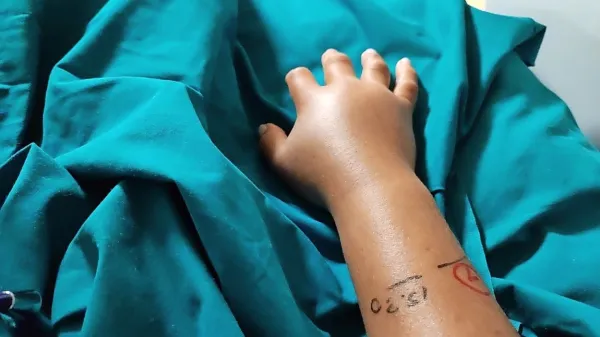 Zatekla roka nesrečne izletnice 24 ur po ugrizu modrasa.