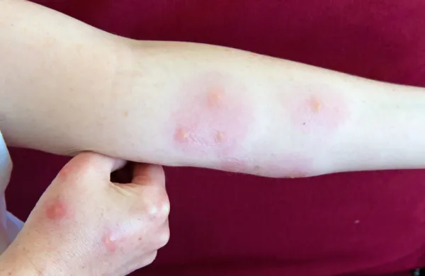 Če se vam na mestu pika pojavi močna lokalna reakcija, oteklino hladite.