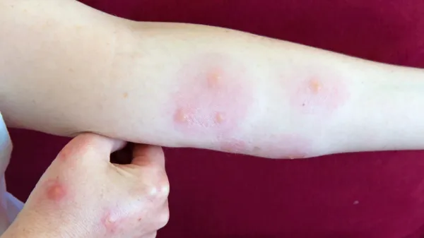 Če se vam na mestu pika pojavi močna lokalna reakcija, oteklino hladite.