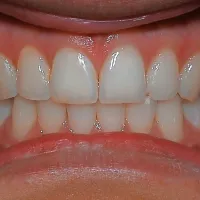 Vsi zavarovanci so po pravilih zdravstvene blagajne doslej imeli 
brez doplačila pravico do bele zalivke le na prvih treh zobeh, se pa 
pravica do bele zalivke širi, najprej na osebe do 26. leta starosti. 