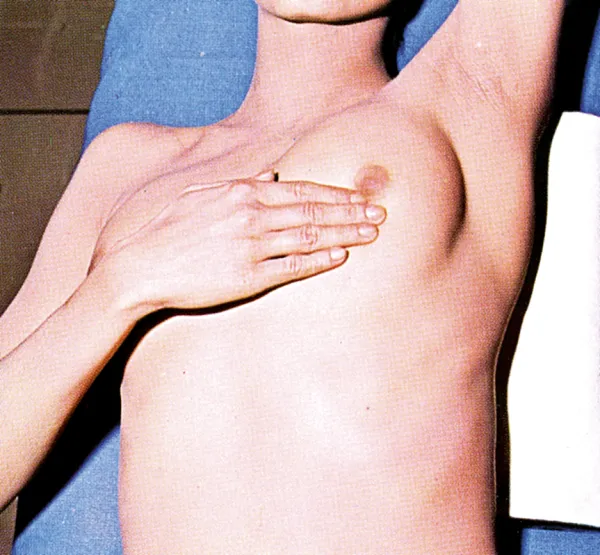 Rakavi bolniki na poti zdravljenja niso sami