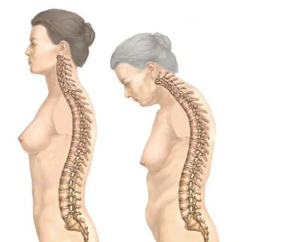 Osteoporoza - brez diagnoze in zdravljenja je kar 60 odstotkov obolelih