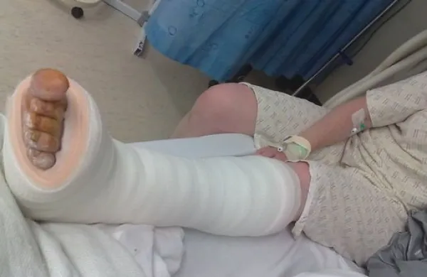 Osteoporoza - brez diagnoze in zdravljenja je kar 60 odstotkov obolelih