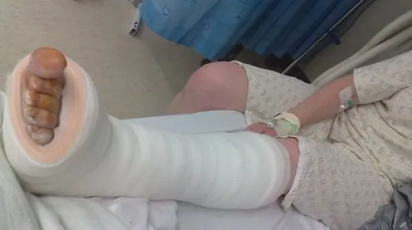 Osteoporoza - brez diagnoze in zdravljenja je kar 60 odstotkov obolelih