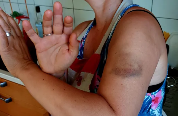 nasilje ženska nad žensko modrice plavice