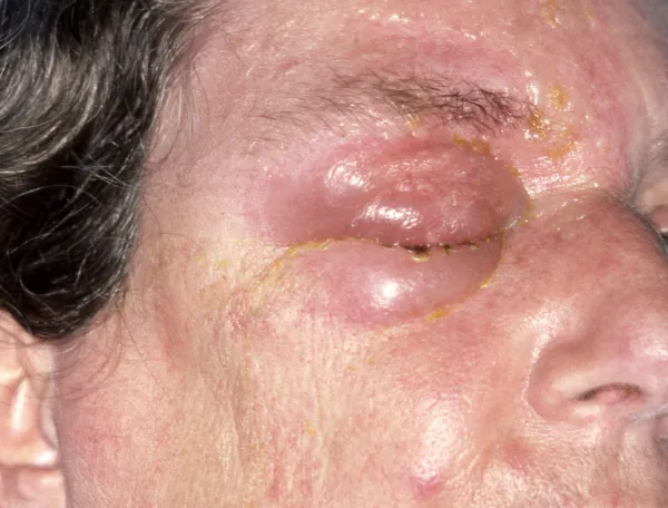 Editorial use only Ophthalmic shingles in the face of a 62 year old female patient. Also known as herpes zoster ophthalmicus, this is a reactivation of the chickenpox virus that affects the eye and the top part of the face. The first symptoms are a tingling, itching or burning sensation which then develops into a red, painful rash, fluid-filled blisters, and eyelid swelling. Due to the risk of serious eye complications, it is crucial to seek medical attention immediately. This may include antiviral medication and steroid eye drops.,Image: 1050410701, License: Rights-managed, Restrictions: Editorial use only Model Released, Model Release: yes, Credit line: PDC/Sciencephoto/Profimedia