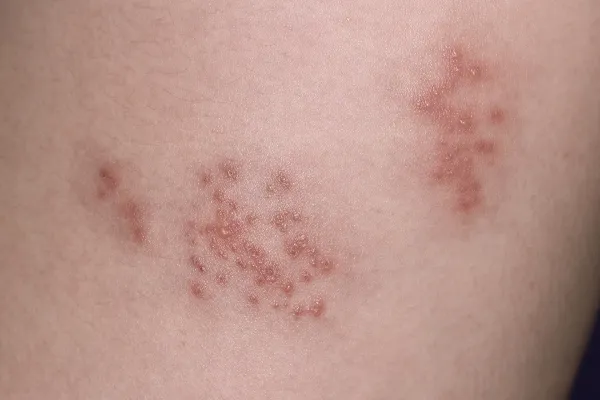 Editoria use only Shingles, or herpes zoster, rash on a patient's skin. Shingles is a disease caused by the varicella-zoster virus, which also causes chickenpox. The virus infects sensory nerves, causing the outbreak of small blisters on the skin supplied by the nerves. These are highly infectious as they are filled with fluid containing virus particles. They last around two weeks, after which the area is intensely painful due to nerve damage. Early treatment with antiviral drugs can prevent the pain, but the virus can lie dormant in nerves for years, and nearly always recurs.,Image: 1063873270, License: Rights-managed, Restrictions: Editoria use only Model Released, Model Release: yes, Credit line: PDC/Sciencephoto/Profimedia