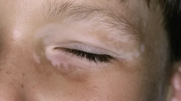 Editoria use only Vitiligo on a 30 year old woman's face. Vitiligo (leukoderma) is a chronic skin condition that causes loss of pigment resulting in irregular patches of pale skin.,Image: 1063875969, License: Rights-managed, Restrictions: Editoria use only Model Released, Model Release: yes, Credit line: PDC/Sciencephoto/Profimedia