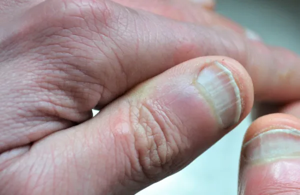 Pri mlaj&scaron;ih ljudeh lahko žlebiči opozarjajo na revmatoidni artritis.